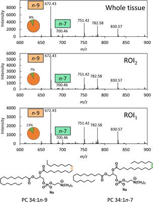 Isomer-Resolved Imaging of Prostate Cancer Tissues Reveals Specific Lipid Unsaturation Profiles Associated With Lymphocytes and Abnormal Prostate Epithelia